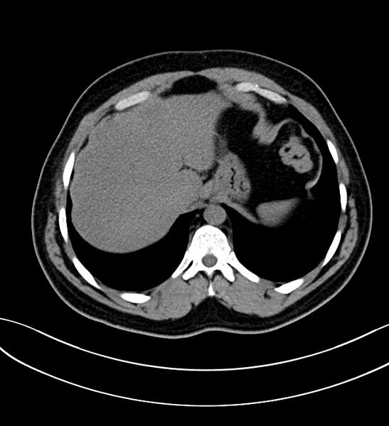 File:Chromophobe renal cell carcinoma (Radiopaedia 84286-99573 Axial non-contrast 2).jpg