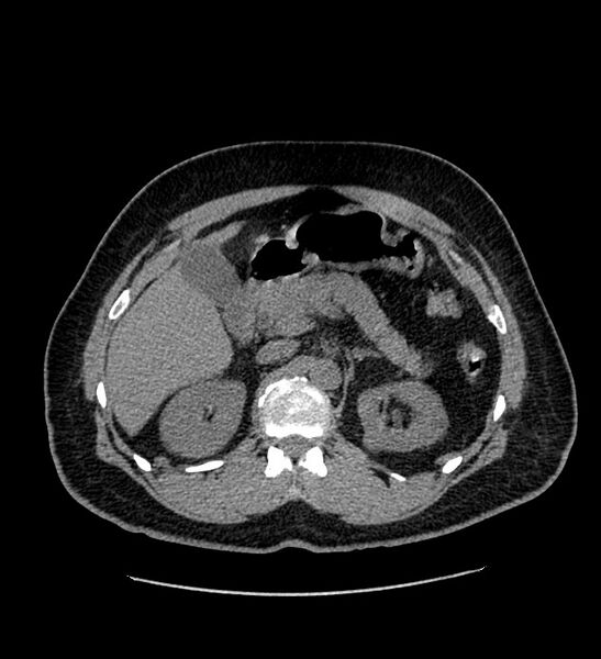 File:Chromophobe renal cell carcinoma (Radiopaedia 84337-99693 Axial non-contrast 42).jpg