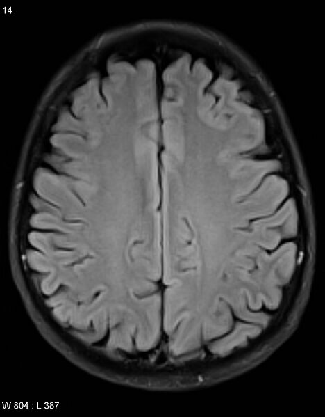 File:Chronic lymphocytic inflammation with pontine perivascular enhancement responsive to steroids (CLIPPERS) (Radiopaedia 37520-39374 Axial FLAIR 13).jpg