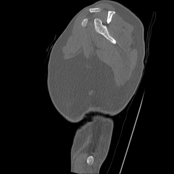 File:Chronic osteomyelitis (Radiopaedia 67597-76998 Sagittal bone window 2).jpg