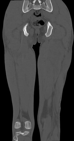 File:Chronic osteomyelitis (with sequestrum) (Radiopaedia 74813-85822 Coronal non-contrast 41).jpg