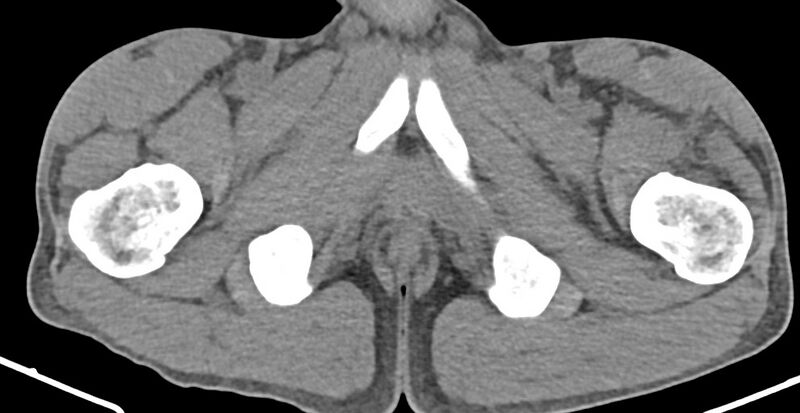File:Chronic osteomyelitis (with sequestrum) (Radiopaedia 74813-85822 D 51).jpg