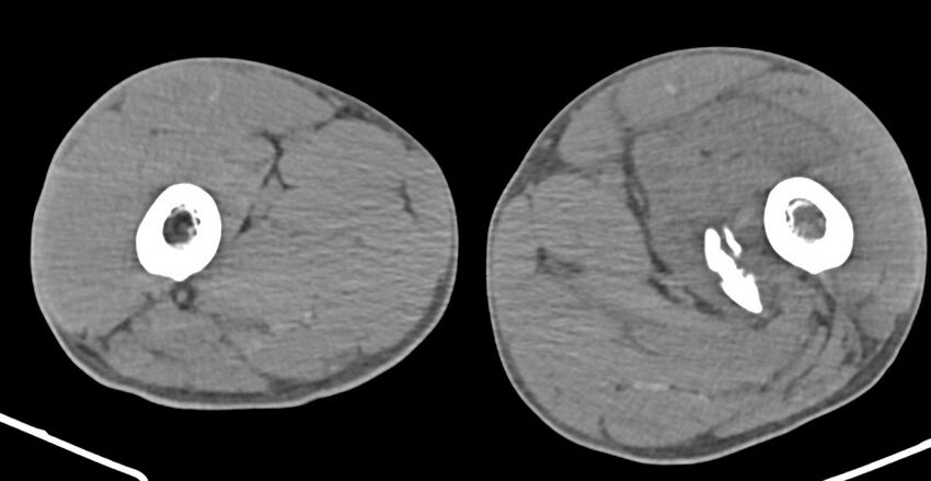 Chronic osteomyelitis (with sequestrum) (Radiopaedia 74813-85822 D 76).jpg