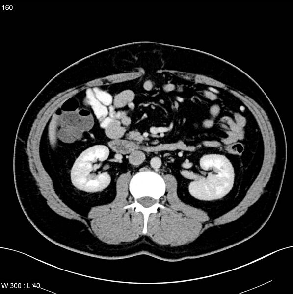 File:Chronic pancreatitis and pseudocysts (Radiopaedia 6724-7935 D 14).jpg
