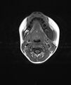 Chronic reactive multifocal osteomyelitis (CRMO) - mandible (Radiopaedia 56405-63069 Axial T1 9).jpg