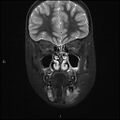 Chronic reactive multifocal osteomyelitis (CRMO) - mandible (Radiopaedia 56405-63069 Coronal STIR 11).jpg