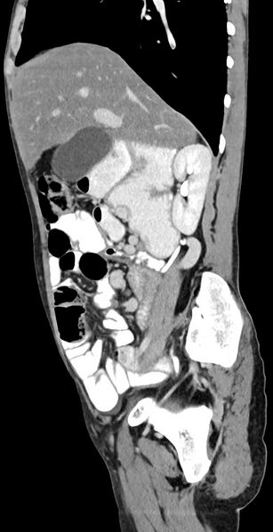 File:Chronic small bowel volvulus (Radiopaedia 75224-86322 C 97).jpg