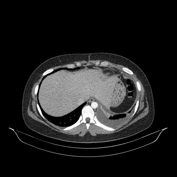 File:Chronic thromboembolic pulmonary hypertension (CTEPH) (Radiopaedia 74597-85532 Axial C+ CTPA 32).jpg
