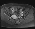 Class II Mullerian duct anomaly- unicornuate uterus with rudimentary horn and non-communicating cavity (Radiopaedia 39441-41755 Axial T1 fat sat 52).jpg