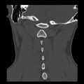 Clay-shoveler fracture (Radiopaedia 22568-22590 Coronal bone window 29).jpg