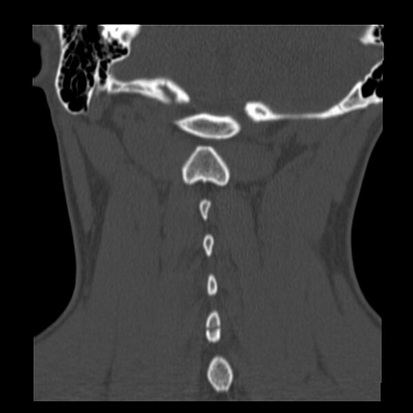 File:Clay-shoveler fracture (Radiopaedia 22568-22590 Coronal bone window 29).jpg