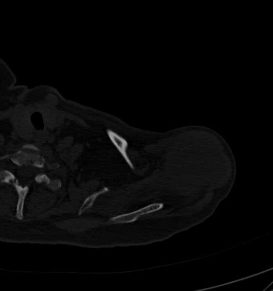 File:Clear cell chondrosarcoma - humerus (Radiopaedia 63104-71612 Axial bone window 17).jpg