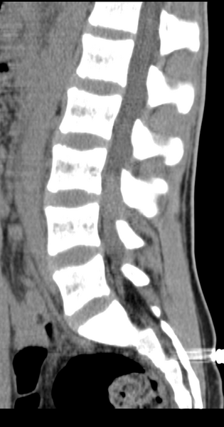File:Clear cell meningoma - lumbar spine (Radiopaedia 60116-67691 A 20).png