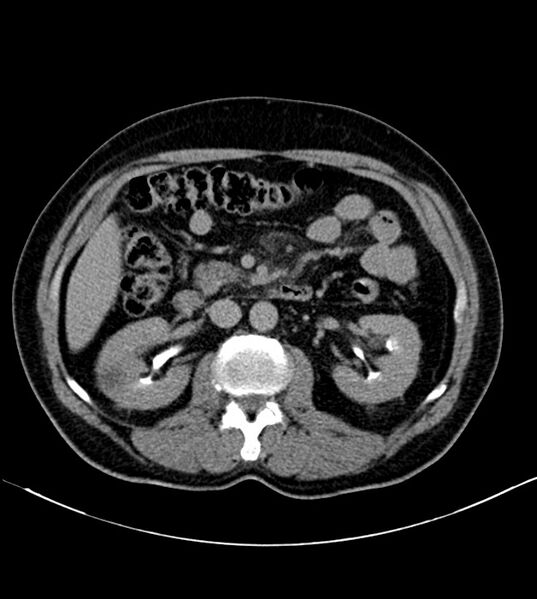 File:Clear cell renal cell carcinoma (Radiopaedia 85006-100539 H 16).jpg