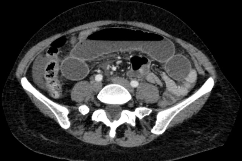 File:Closed loop small bowel obstruction (Radiopaedia 71211-81508 A 88).jpg