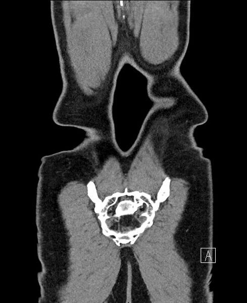 File:Closed loop small bowel obstruction - internal hernia (Radiopaedia 57806-64778 A 117).jpg