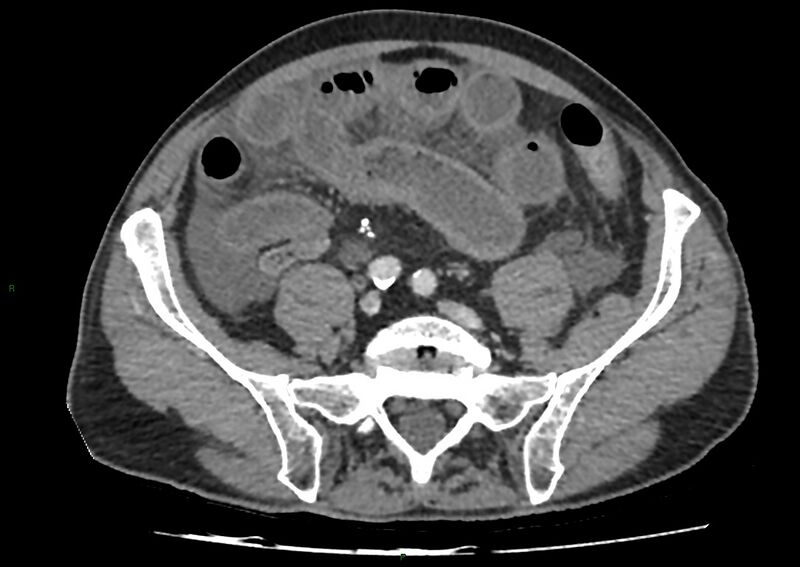 File:Closed loop small bowel obstruction with ischemia (Radiopaedia 84180-99456 A 84).jpg
