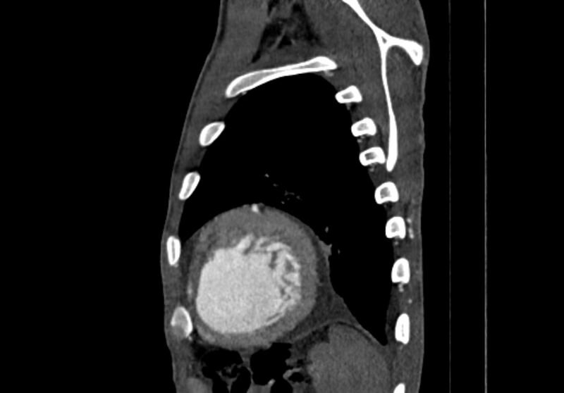 File:Coarctation of aorta with aortic valve stenosis (Radiopaedia 70463-80574 B 205).jpg