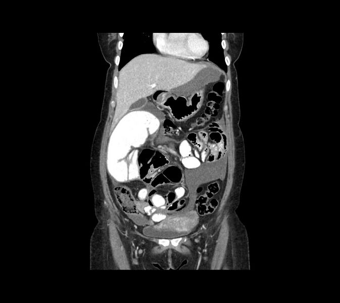 File:Cocoon abdomen with possible tubo-ovarian abscess (Radiopaedia 46235-50636 B 16).jpg
