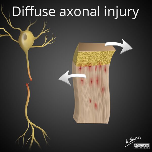 File:Diffuse axonal injury- illustration (Radiopaedia 38437).jpg