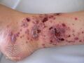 Hypersensitivity vasculitis (DermNet NZ doctors-systemic-images-vasc-hs3).jpg