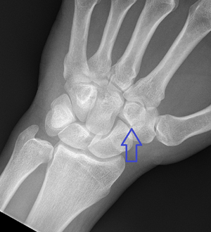 Isolated-trapezoid-fracture-1.png