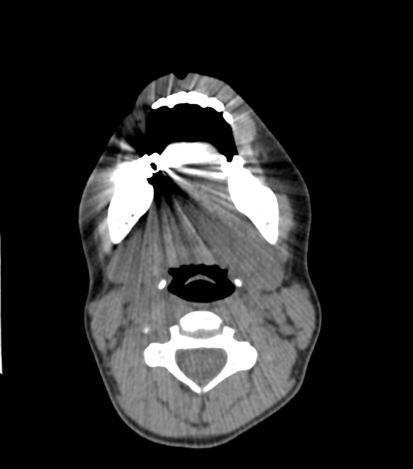 Nasoorbitoethmoid fracture (Radiopaedia 90044-107205 Axial non-contrast 63).jpg
