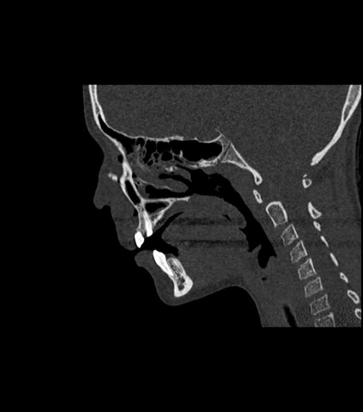 File:Nasoorbitoethmoid fracture (Radiopaedia 90044-107205 Sagittal bone window 65).jpg