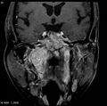 Nasopharyngeal carcinoma (Radiopaedia 4546-6667 E 10).jpg
