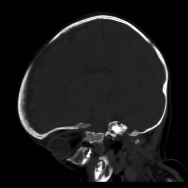 File:Neuroblastoma with skull metastases (Radiopaedia 30326-30958 Sagittal bone window 27).jpg