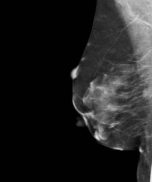 File:Neurofibromatosis of the breast (Radiopaedia 18516-18379 MLO 1).jpg