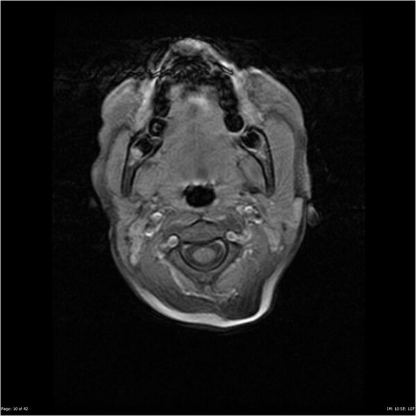 File:Neurofibromatosis type 1 (Radiopaedia 22541-22564 Axial T1 C+ fat sat 10).jpg
