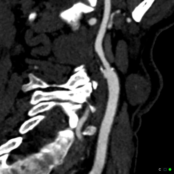 File:Non-occlusive intraluminal internal carotid artery thrombus (Radiopaedia 37751-39658 C 11).jpg