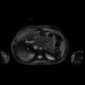 Normal MRI abdomen in pregnancy (Radiopaedia 88001-104541 D 12).jpg