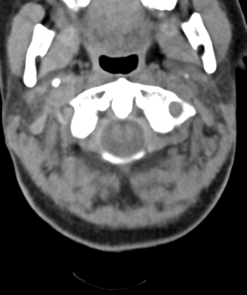 File:Normal cervical spine MRI (including Dixon) (Radiopaedia 42762-45926 Axial non-contrast 11).png