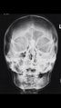Normal facial bones (Radiopaedia 46261-50669 Frontal 1).PNG