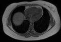 Normal liver MRI with Gadolinium (Radiopaedia 58913-66163 Axial T1 in-phase 31).jpg