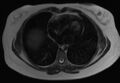 Normal liver MRI with Gadolinium (Radiopaedia 58913-66163 Axial T2 33).jpg