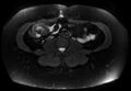 Normal liver MRI with Gadolinium (Radiopaedia 58913-66163 Axial T2 fat sat 4).jpg