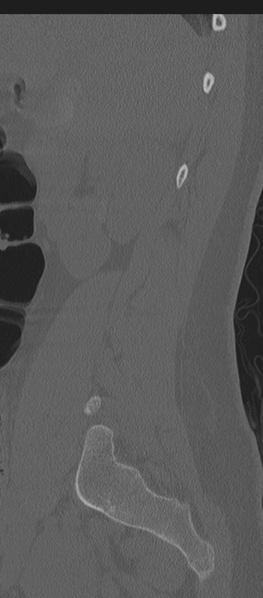 File:Normal lumbosacral CT (Radiopaedia 37923-39867 Sagittal bone window 78).png