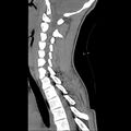 Normal trauma spine imaging (age 16) (Radiopaedia 45335-49358 C 15).jpg
