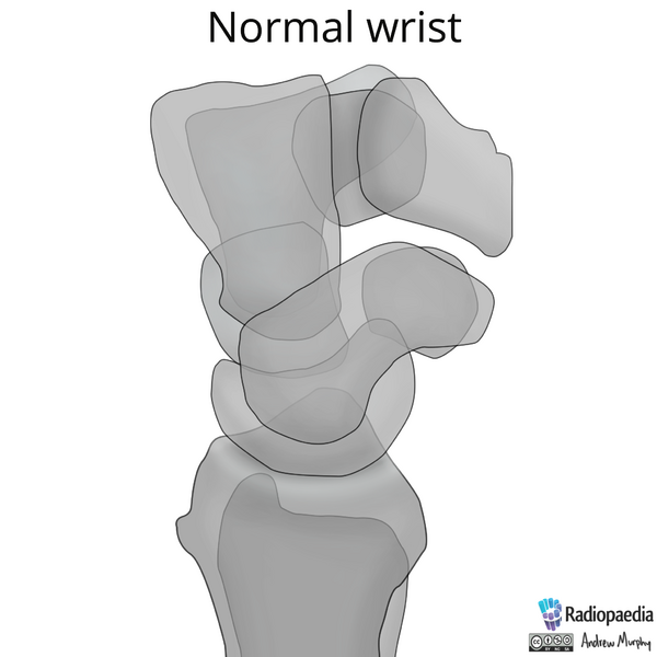 File:Normal wrist alignment, dorsal and volar intercalated segmental instability (illustration) (Radiopaedia 80949-94487 A 1).png