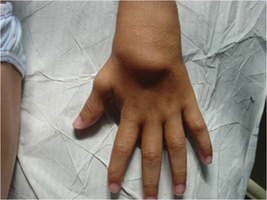 Exuberant ‘boggy’ synovitis of wrist in a child with Blau syndrome.