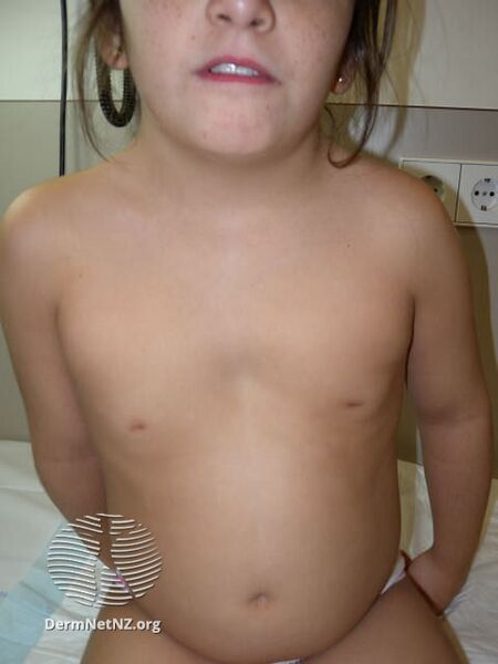 File:Turner syndrome (DermNet NZ turner).jpg