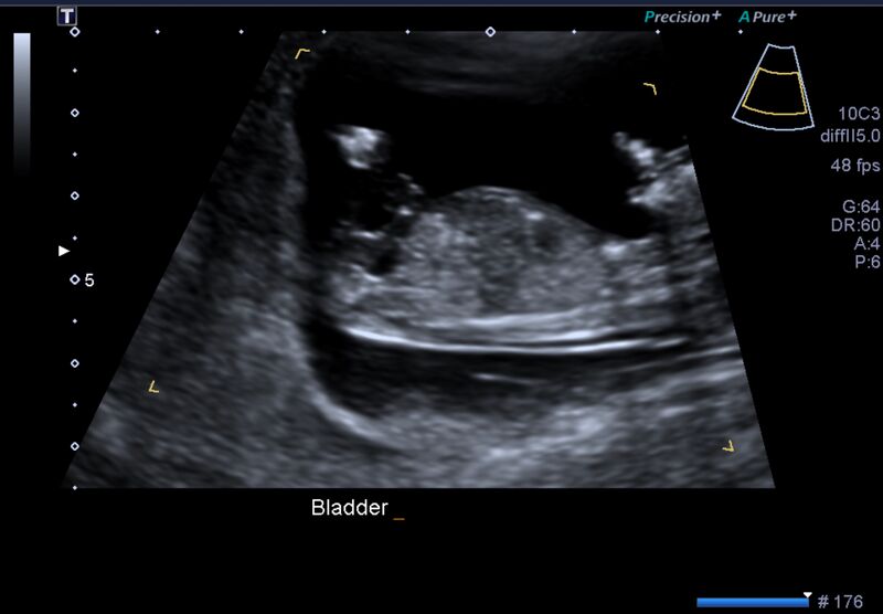 File:1st trimester nuchal-morphology ultrasound (Radiopaedia 44706-48477 General anatomy and NT 40).jpg