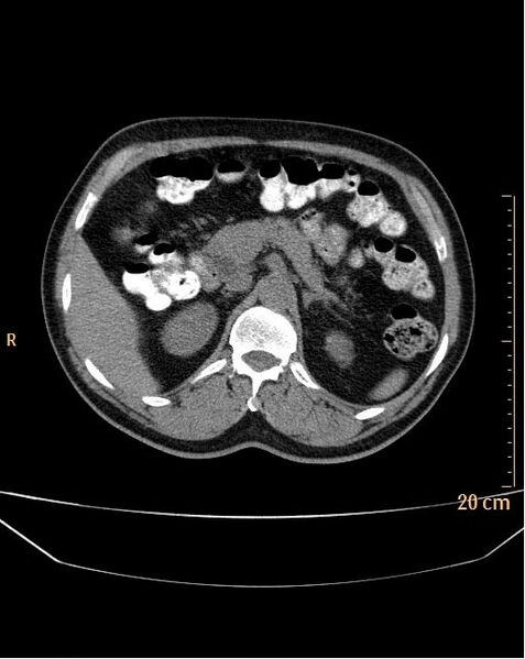 File:Abdominal aortic aneurysm (Radiopaedia 25985-26121 Axial non-contrast 1).jpg