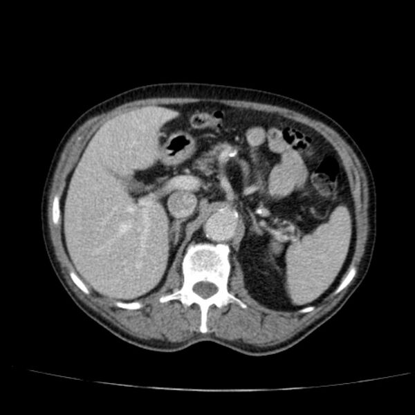 File:Abdominal aortic aneurysm (Radiopaedia 29248-29660 Axial C+ portal venous phase 19).jpg