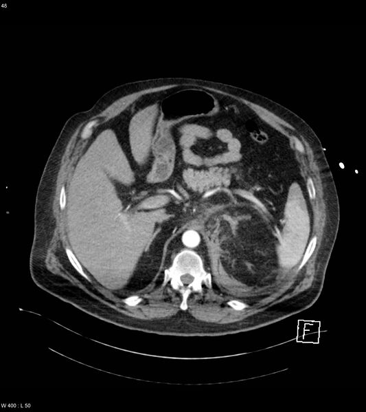 File:Abdominal aortic aneurysm with intramural hematoma then rupture (Radiopaedia 50278-55632 Axial C+ arterial phase 47).jpg