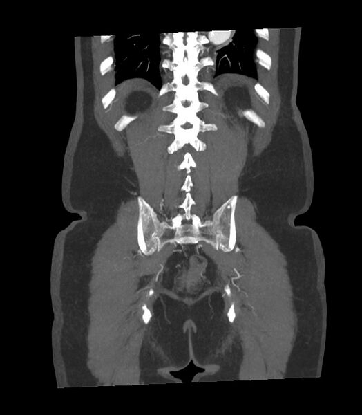 File:Abdominal aortic aneurysm with thrombus fissuration (Radiopaedia 46218-50618 Coronal C+ arterial phase 4).jpg