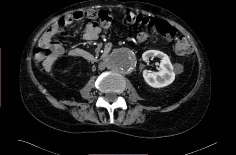 File:Abdominal aortic interposition tube graft and aneurysm thrombosis (Radiopaedia 71438-81857 Axial C+ arterial phase 83).jpg